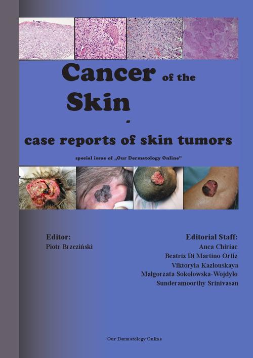 Скачать Cancer of the Skin - case reports of skin tumors - Piotr Brzezinski